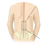 treatment selective dorsal rhyzotomy